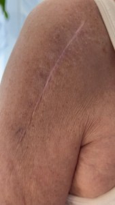 Ärrvävnadsbehandling MSTR behandling av ärr